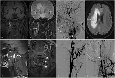 Retrospective Comparative Analysis of Clinical and Imaging Features of Craniocervical Artery Dissection: Spontaneous CAD vs. Minor Traumatic CAD